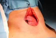 Tiroid Nodül Ameliyatı Sonrası Tiroid Nodül Ameliyatı Sonrası