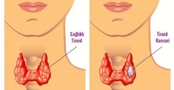 Tiroid Kanseri Belirtileri ve Tedavisi Tiroid Kanseri Belirtileri ve Tedavisi