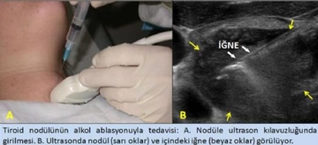 Tiroid Kistik Nodül Tedavi Tiroid Kistik Nodül Tedavi