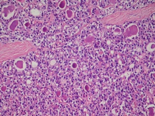 Tiroid Papiller Ca Hastalığın Belirtisi Tiroid Papiller Ca Hastalığın Belirtisi