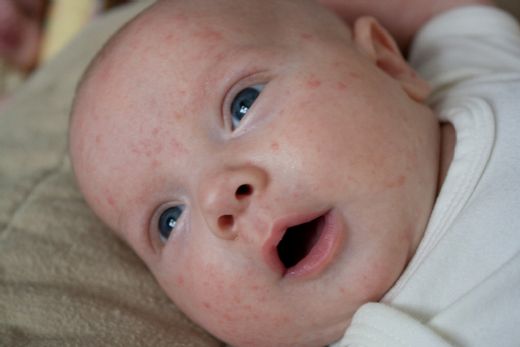 Bebeklerde Tiroid Hormonu Yüksekliği
