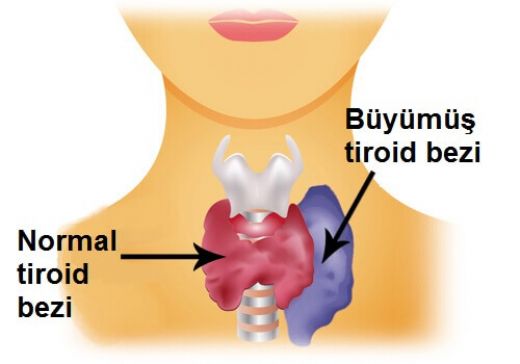 Tiroid Bezinin Az almas Bitkisel Tedavi