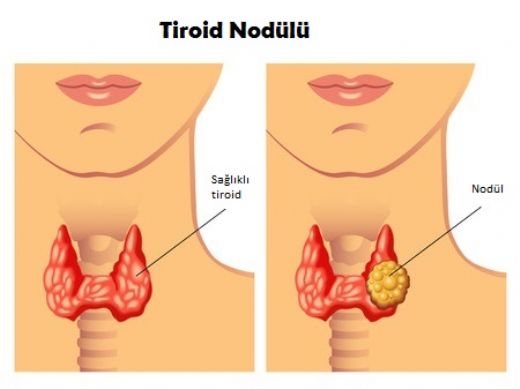Tiroid Nodülü
